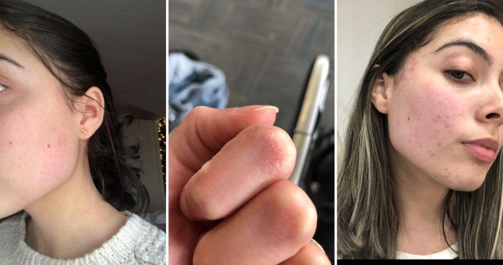 Diário da alergia: como descobri as alergias que tenho